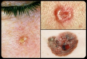 Skin Cancer summerskin_rm_collage_of_precancerous_skin_growths_s17