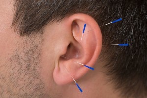 accupuncture shutterstock_244873000 FB