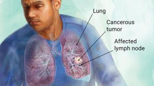 Lung Cancer